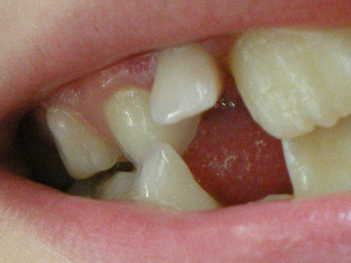 loose-tooth
